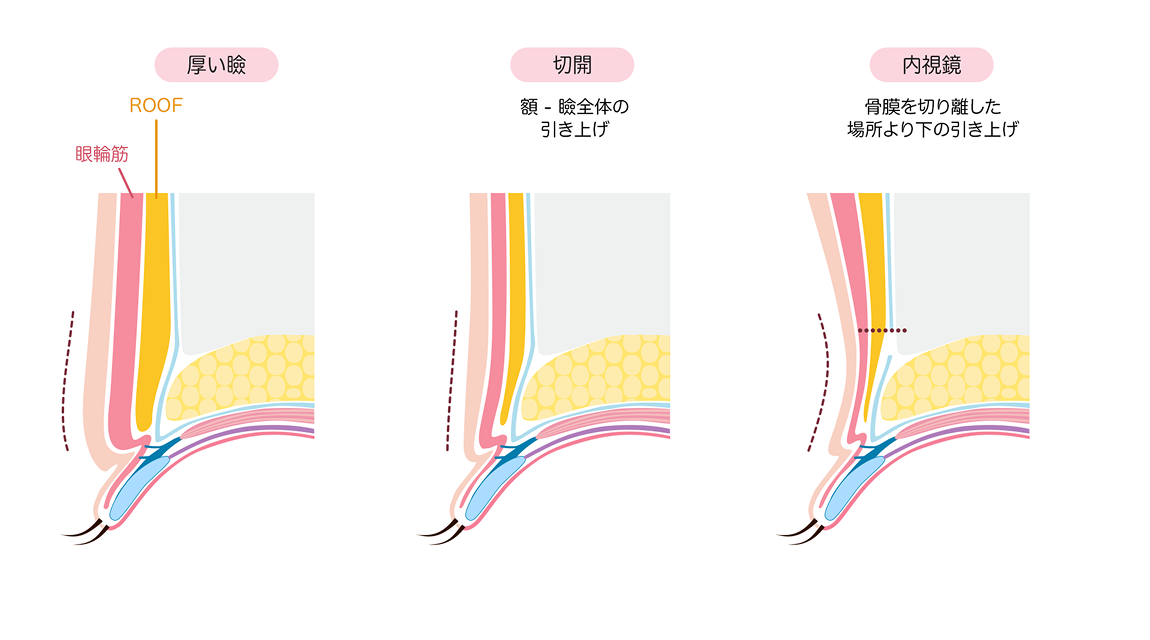厚い瞼・切開・内視鏡の図解
