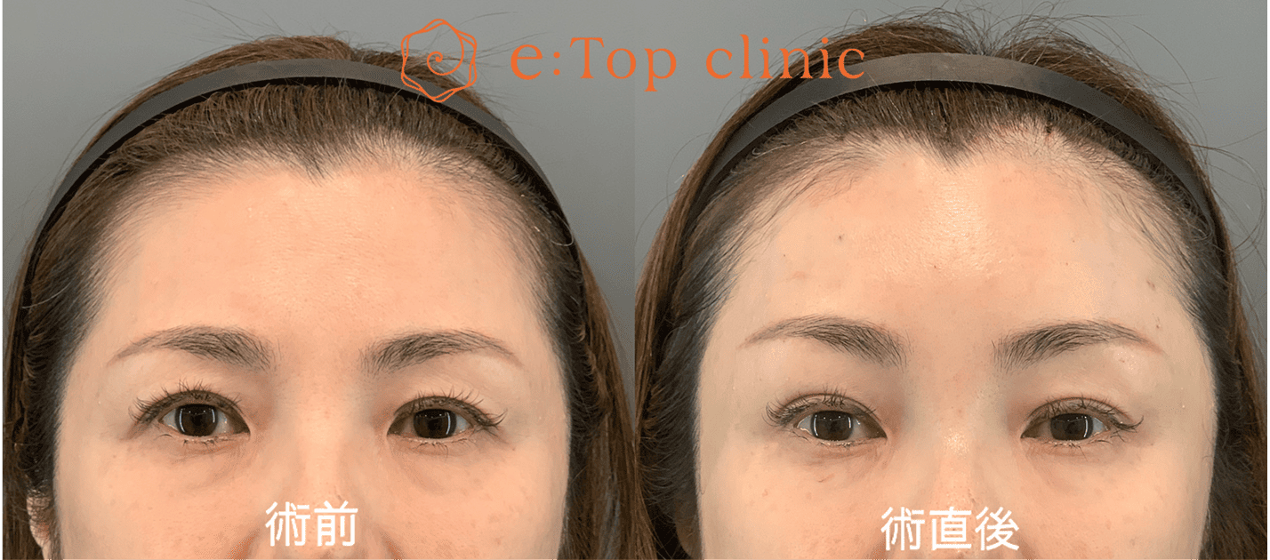 症例 術前・術直後