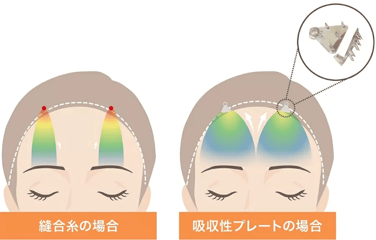 吸収性プレートの仕組み