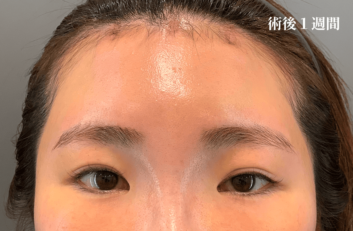 ダウンタイムの様子