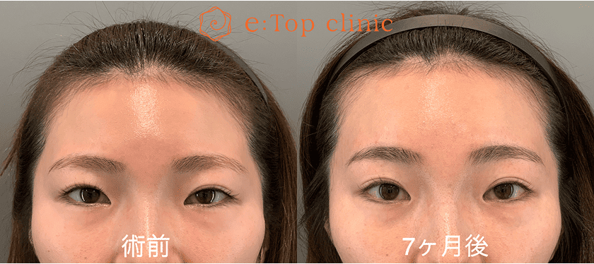 自然な仕上がり 術前・7ヶ月後