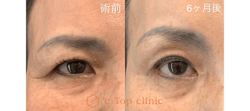 上顔面全体をリフトアップ 術前・6ヶ月後