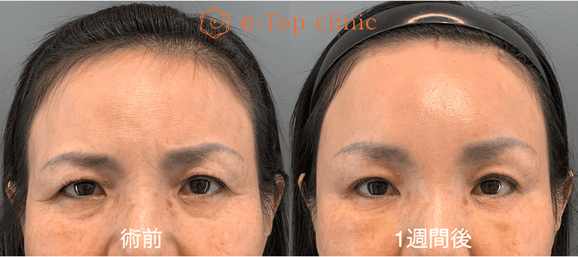 ダウンタイム 術前・1週間後