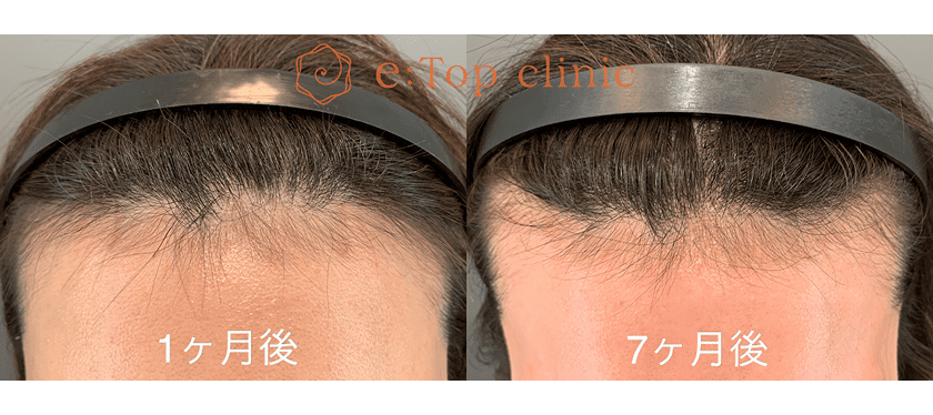 傷跡の仕上がり 1ヶ月後・7ヶ月後