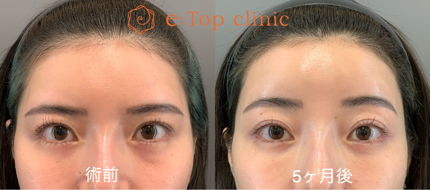 症例写真 術前・5ヶ月後
