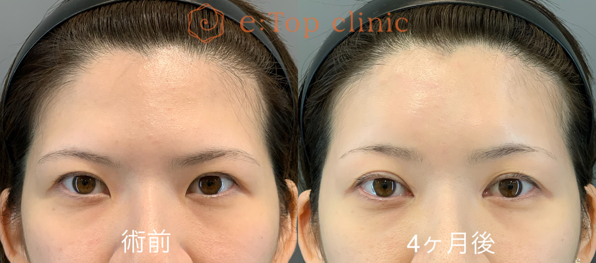 症例写真 術前・4ヶ月後