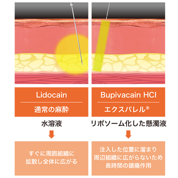 エクスパレル 説明画像