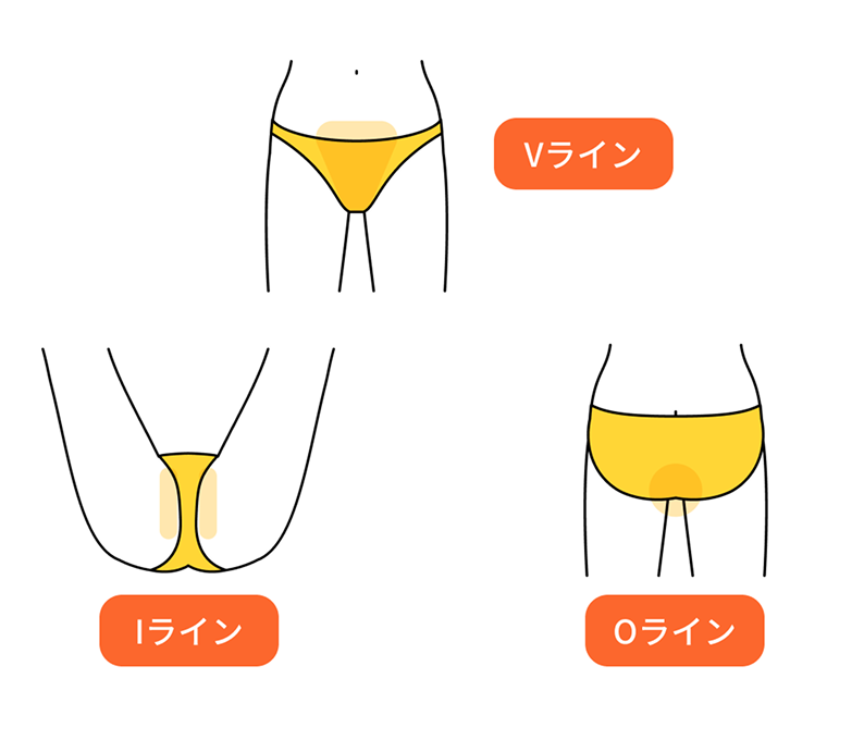 VIOの脱毛部位