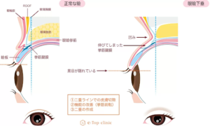 加齢でまぶたが下がる眼瞼下垂とは?原因やセルフチェック法、治療法を解説|東京・赤坂の美容外科イートップクリニック