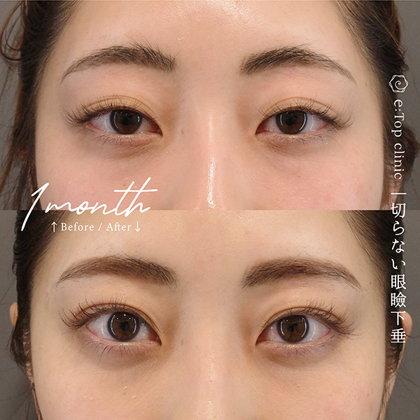 切らない眼瞼下垂の症例