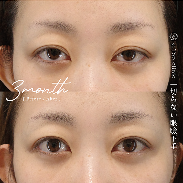 切らない眼瞼下垂の症例