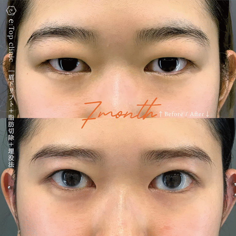 瞼の脂肪取りは意味ない？意味ないといわれる理由や失敗しないための注意点を解説｜東京・赤坂の美容外科イートップクリニック