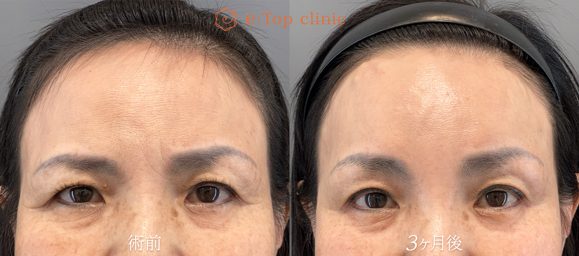 60代の症例実績 Before After