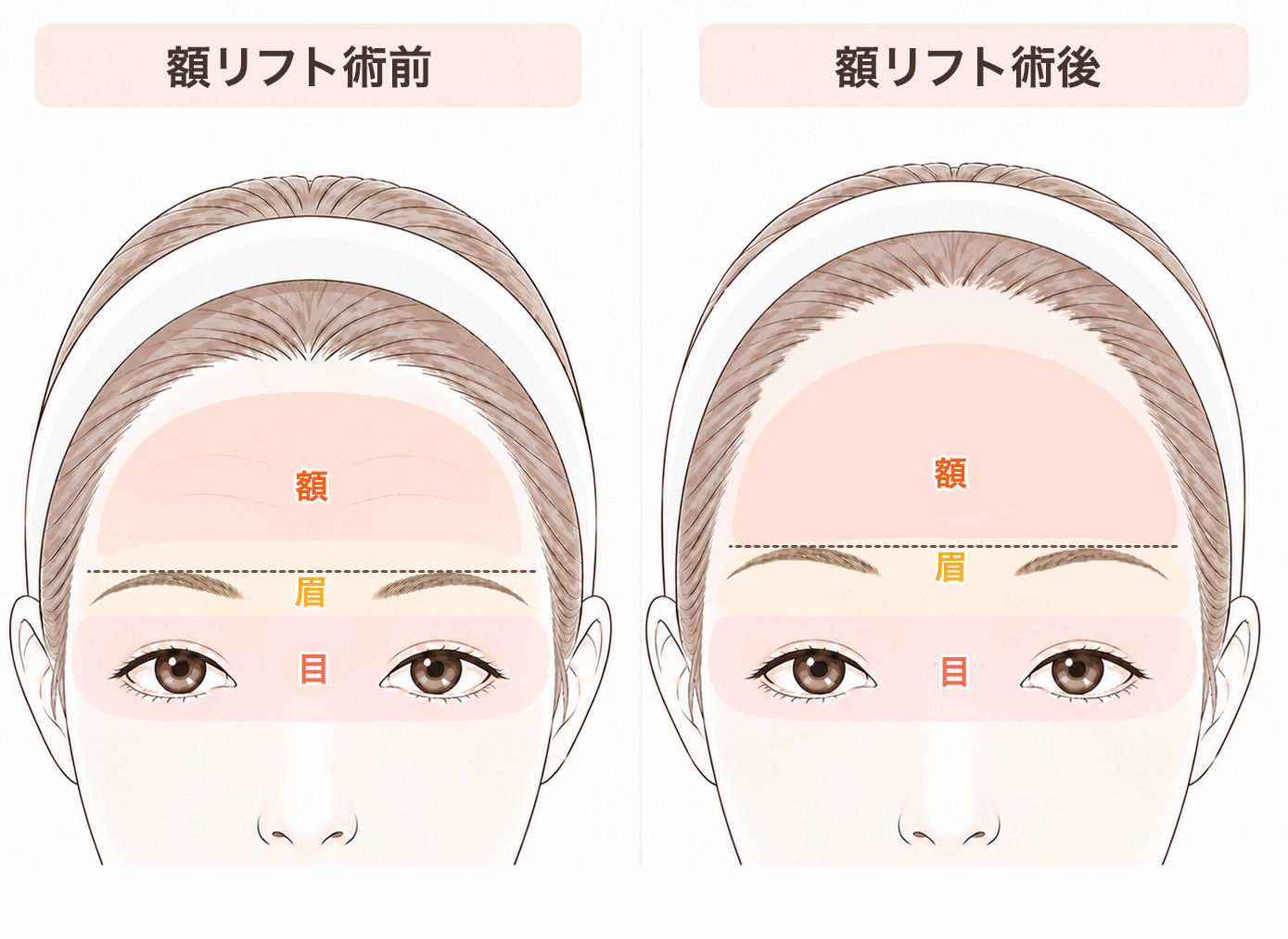 額と瞼の関係図