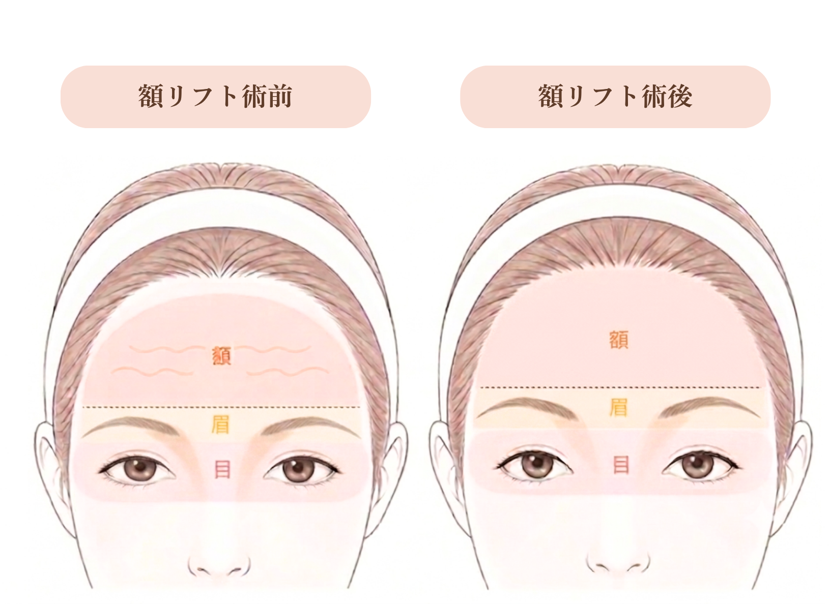 額と瞼の関係図